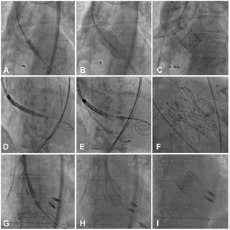 v14n5_Prendergast_Figure_2_Technical aspects of transcatheter aortic valve implantation.jpg