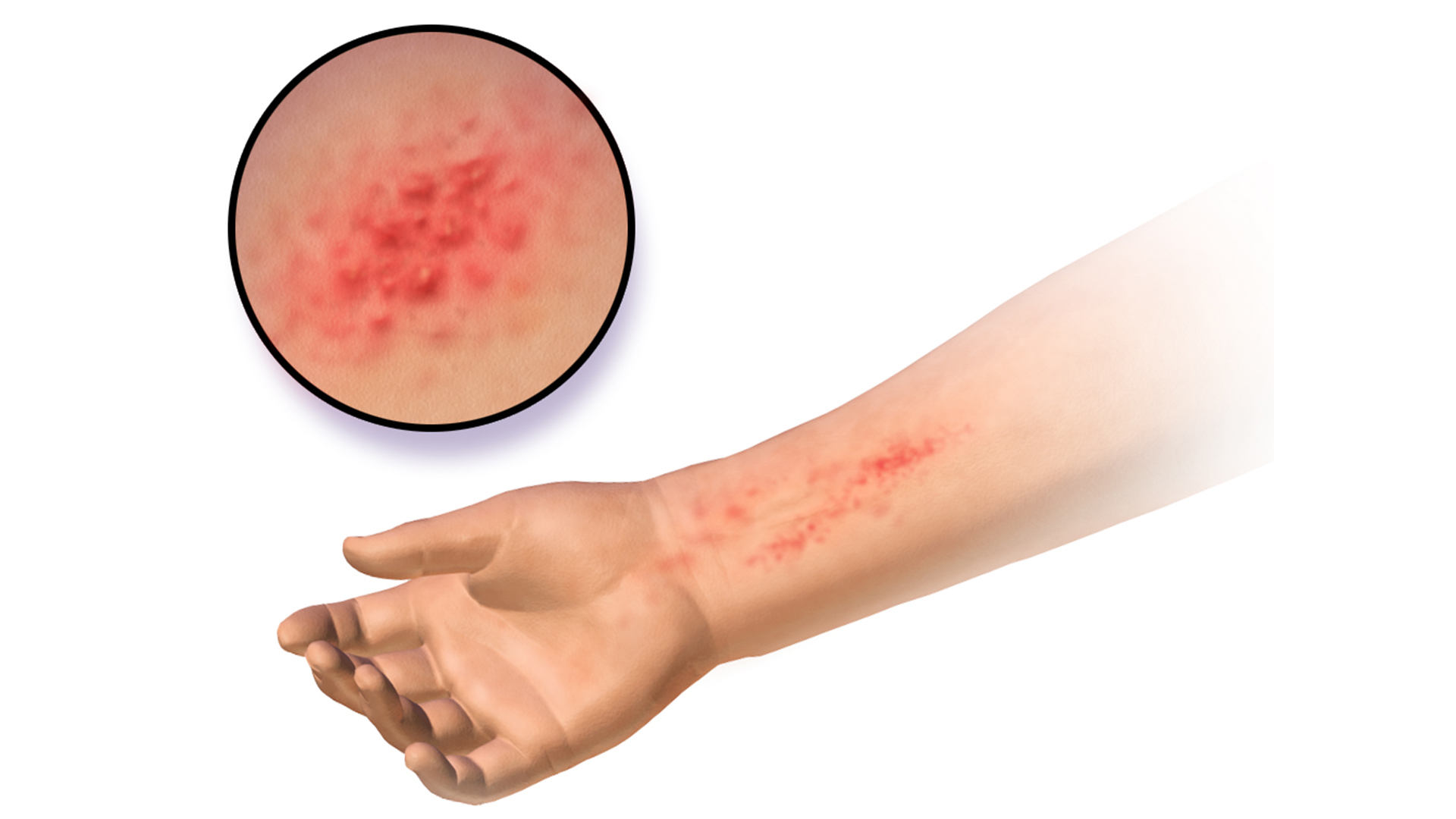 図は、皮膚色が薄い場合の接触皮膚炎の外見の一例だが、発疹の外見は、皮膚がどれだけダメージを負っているかによって異なることに注意してほしい。画像提供：Blausen Medical