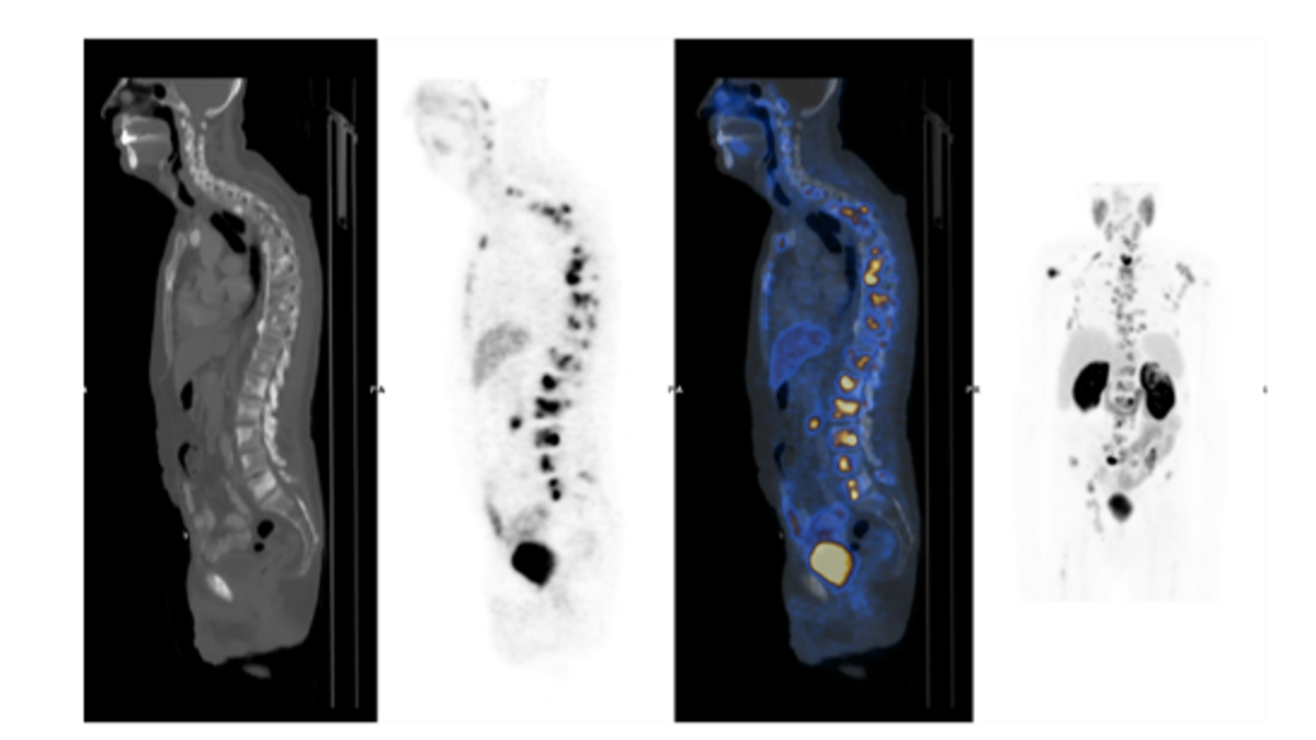 prostate cancer clinical image