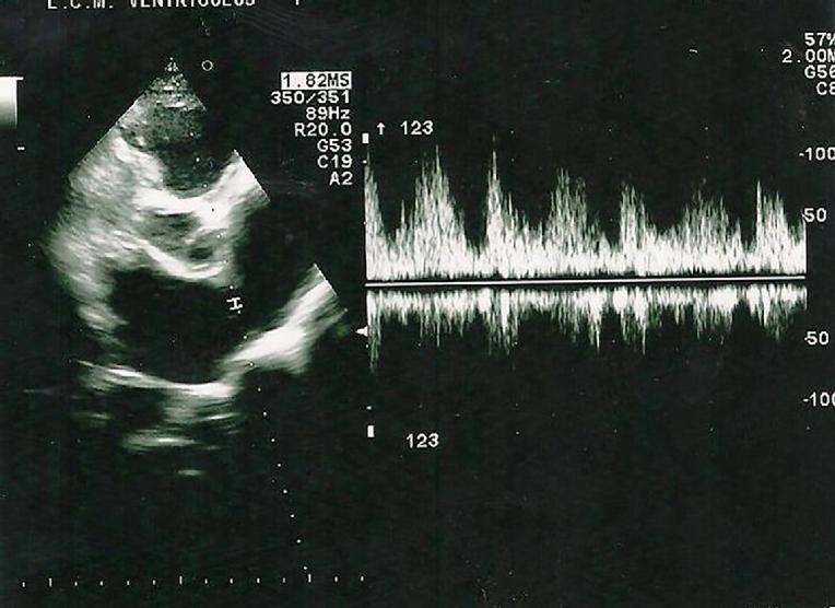 14_35_Figure 2_Heart failure in athletes.jpg