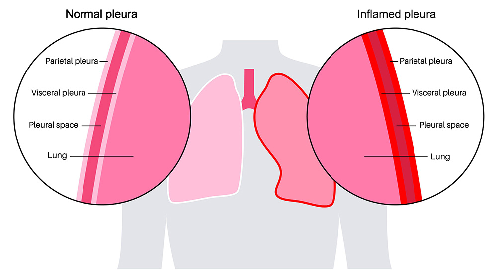 Illustration showing an inflamed pleura.