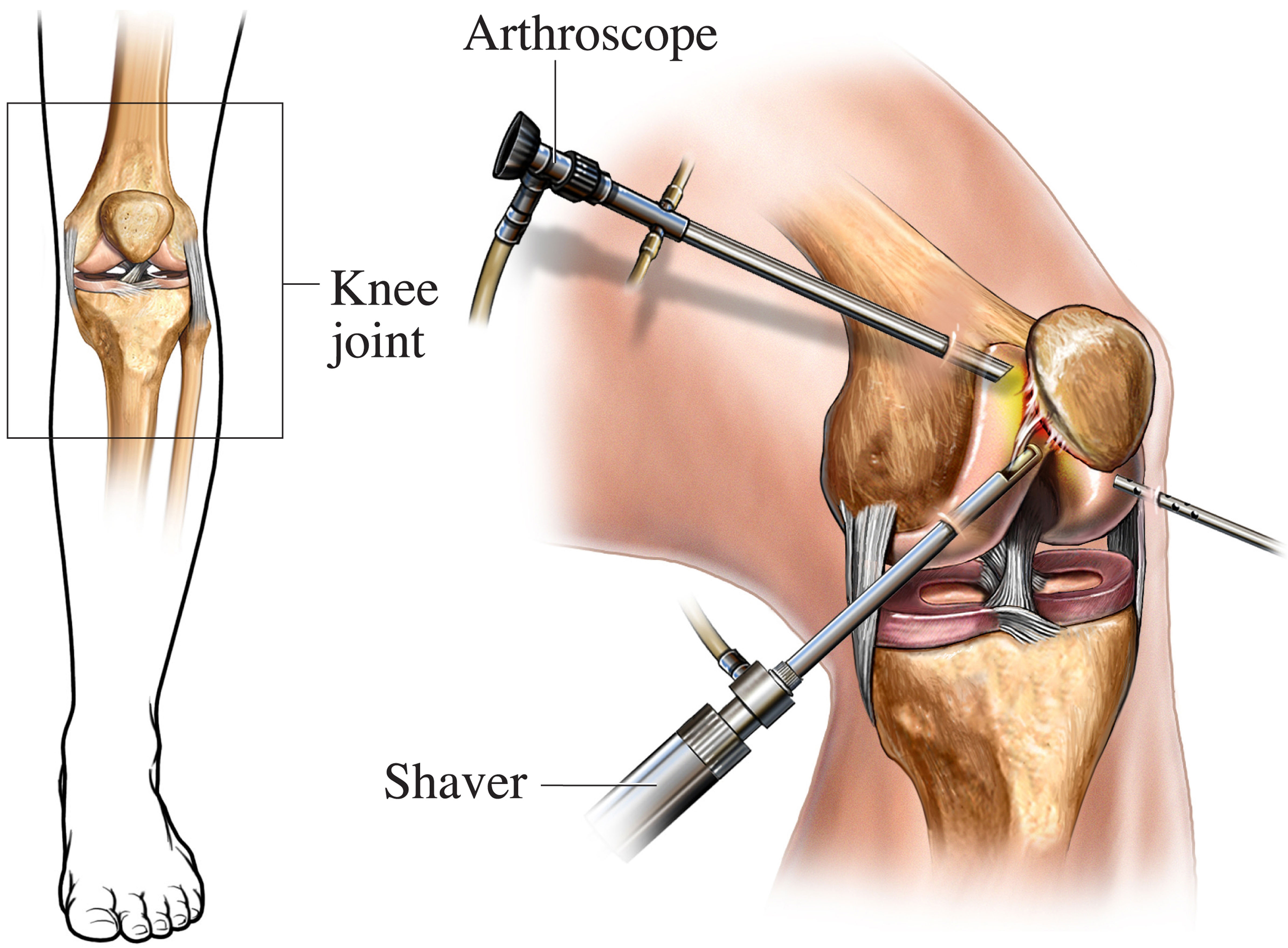 Illustration of an arthroscopy