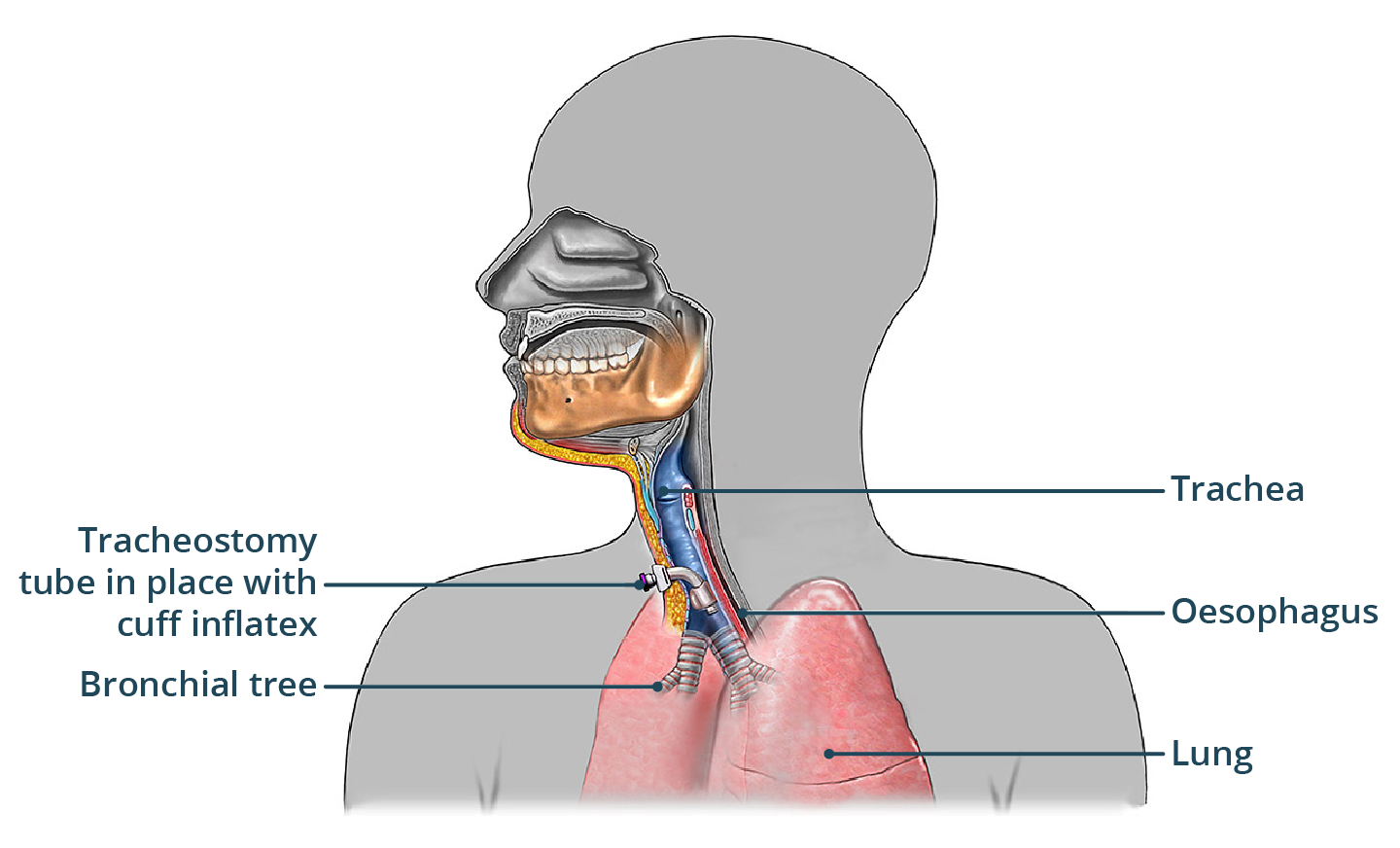 Illustration of a tracheostomy