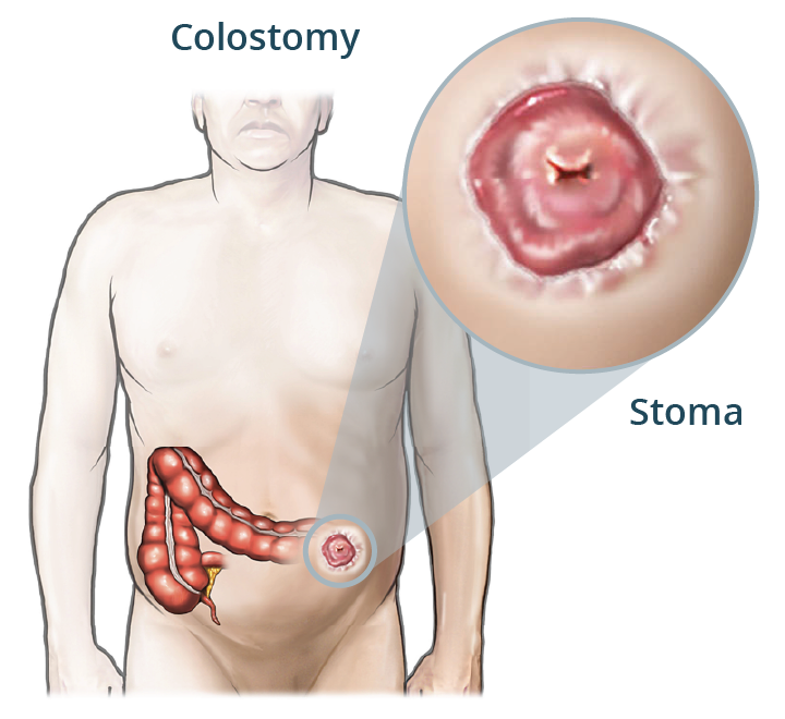 illustration of the large intestine, a colostomy and a stoma.