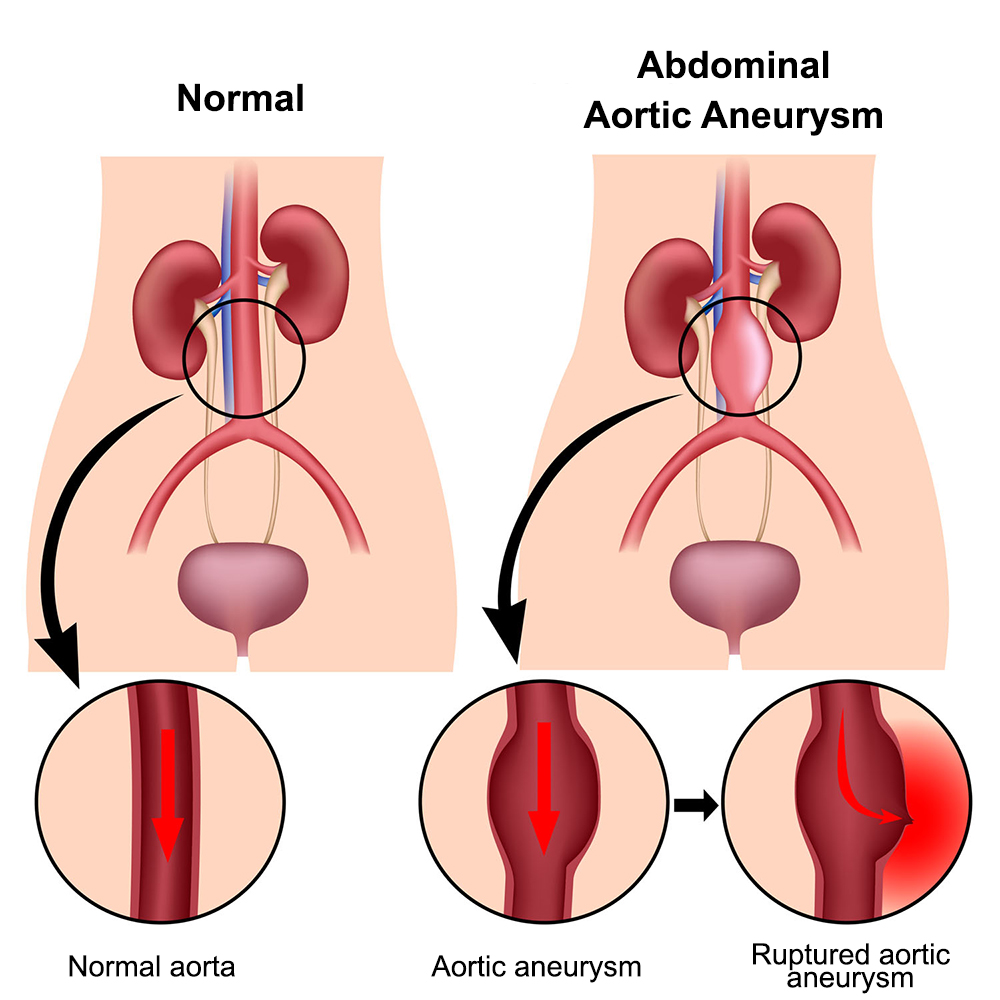 illustration comparing a normal aorta with a ruptured aorta