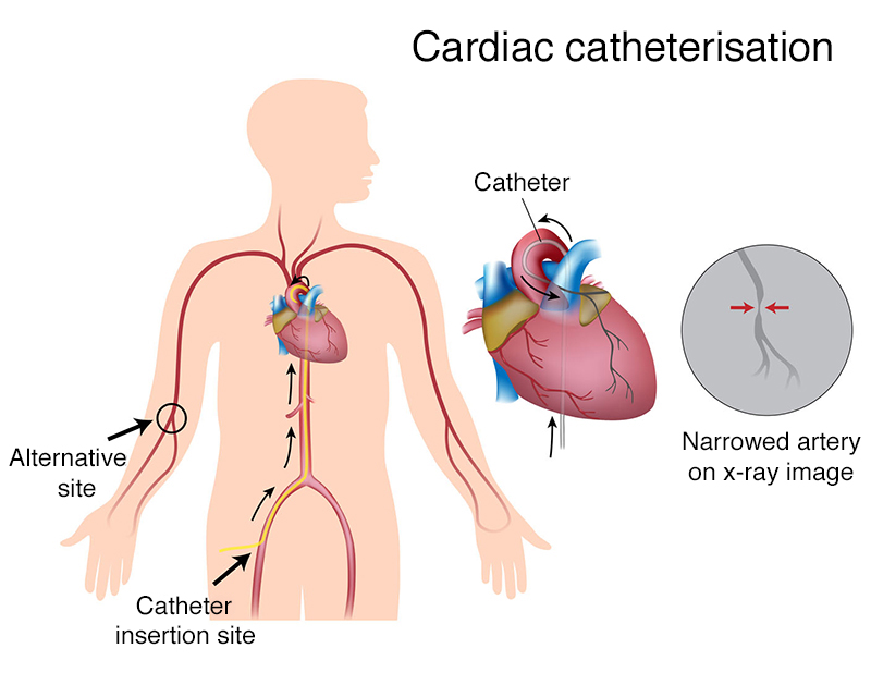 Illustration of a cardiac catheterisation showing the catheter insertion site, alternative site, catheter and narrowed artery on X-ray image