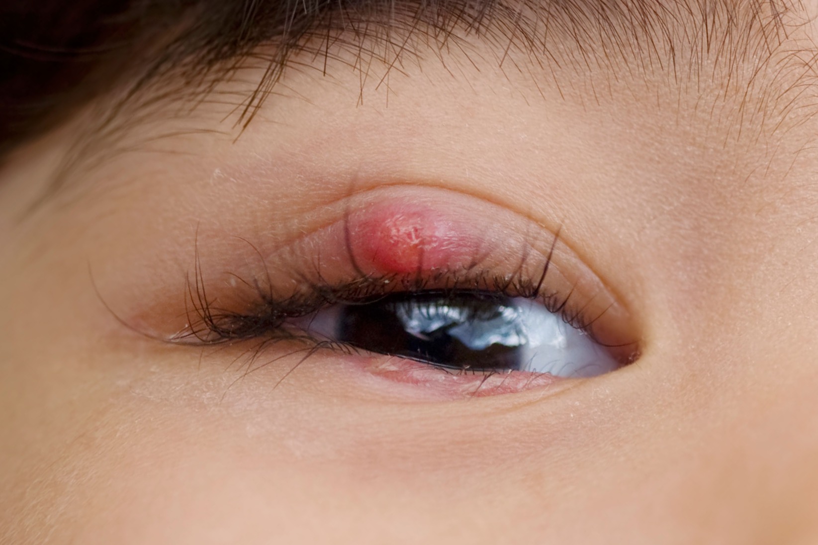 A stye is a small red lump on your eyelid, the glands become blocked and get infected.