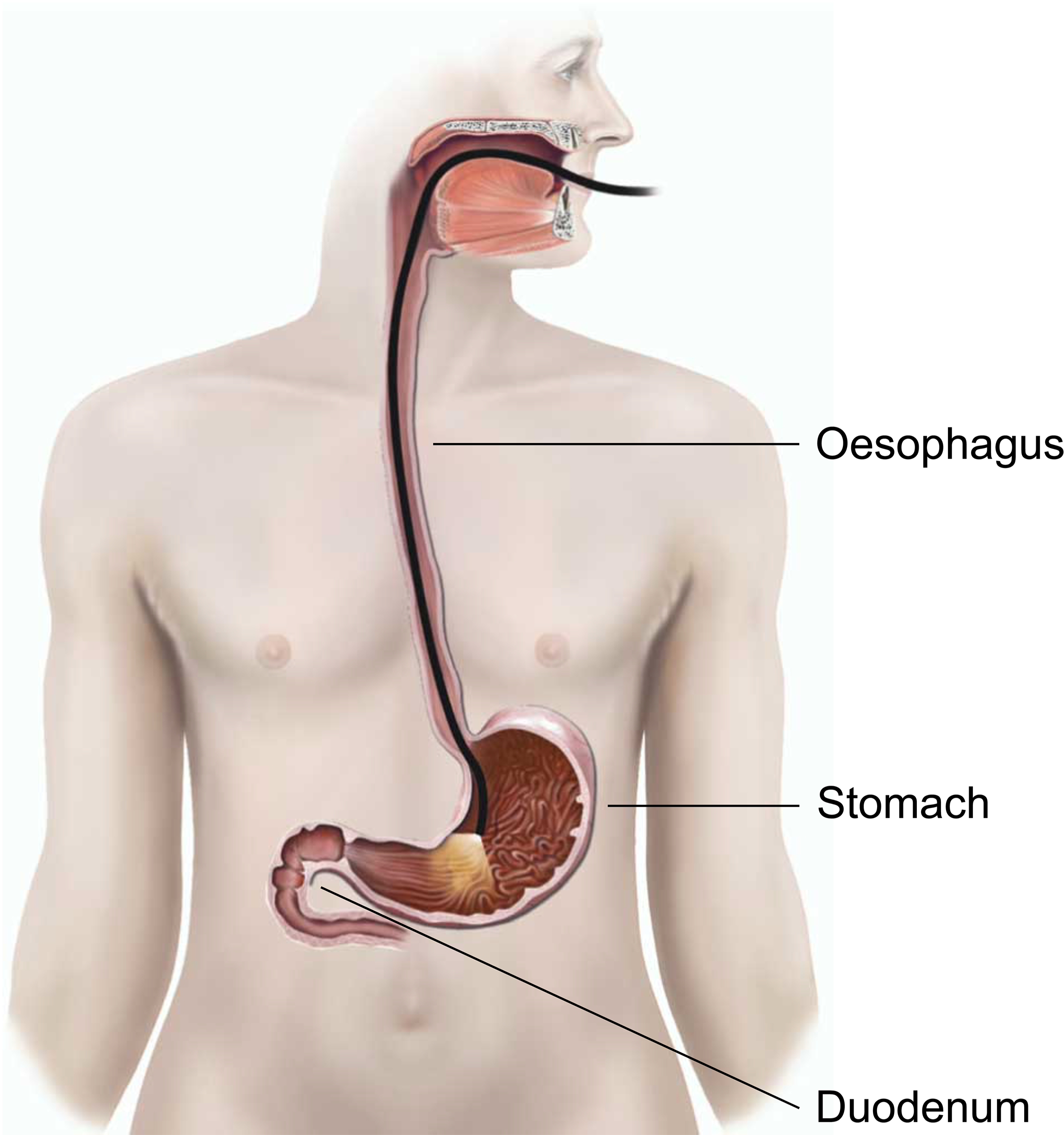 Illustration showing an upper GI endoscopy.