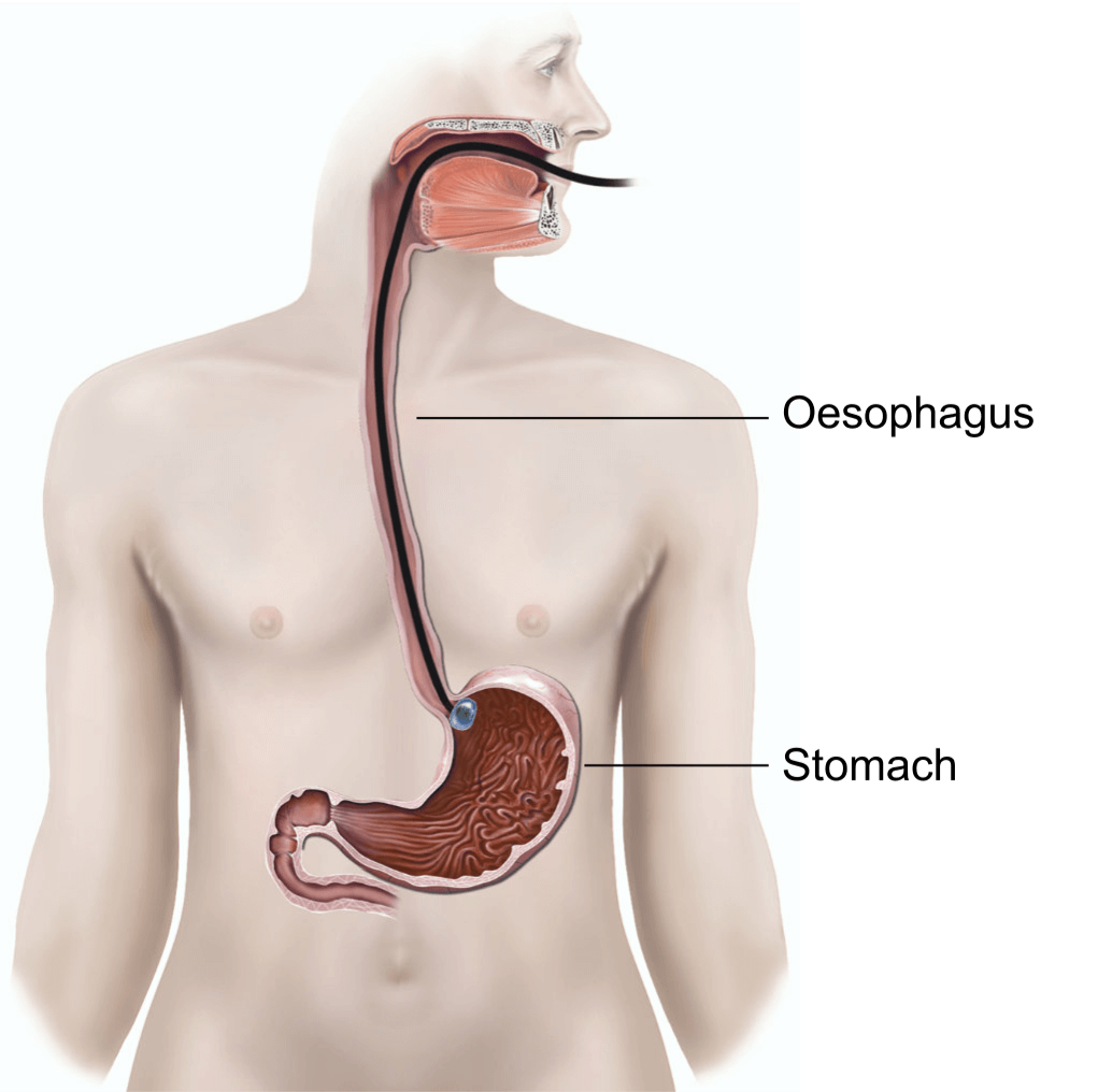 Illustration showing an endoscopic ultrasound.