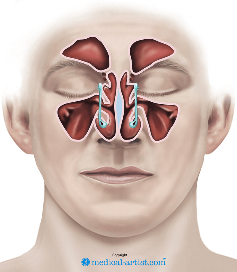 Illustration showing the location of the sinuses; the hollow spaces behind the eyes, nose, forehead and cheeks.