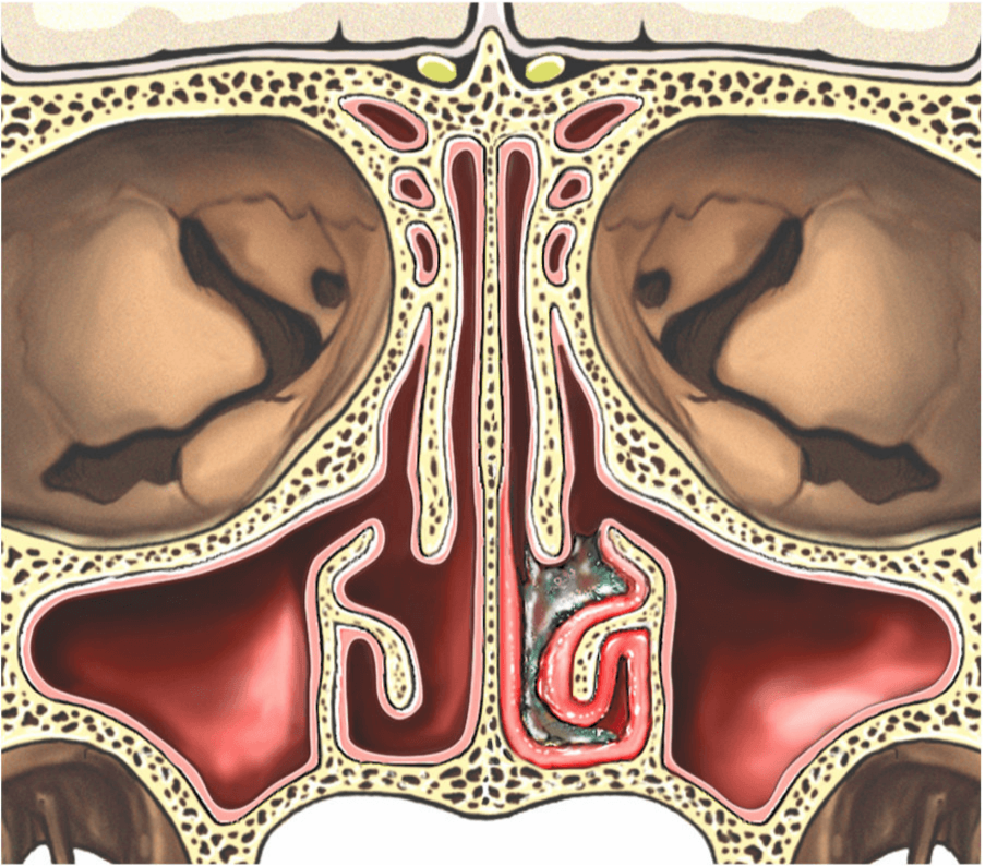 Illustration showing a cross-section of the nasal cavity showing an enlarged inferior turbinate.