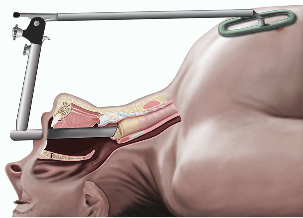 Illustration showing a laryngoscopy; a rigid telescope inserted through the mouth and down into the throat.