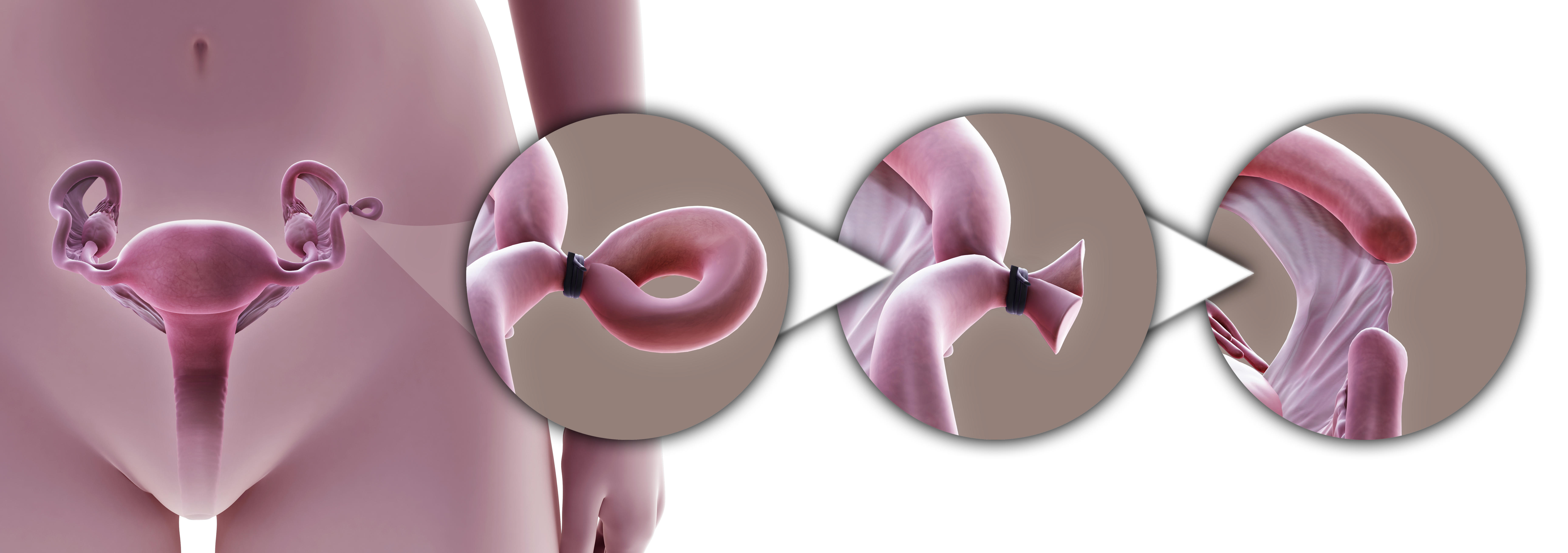 illustration of a tubal ligation
