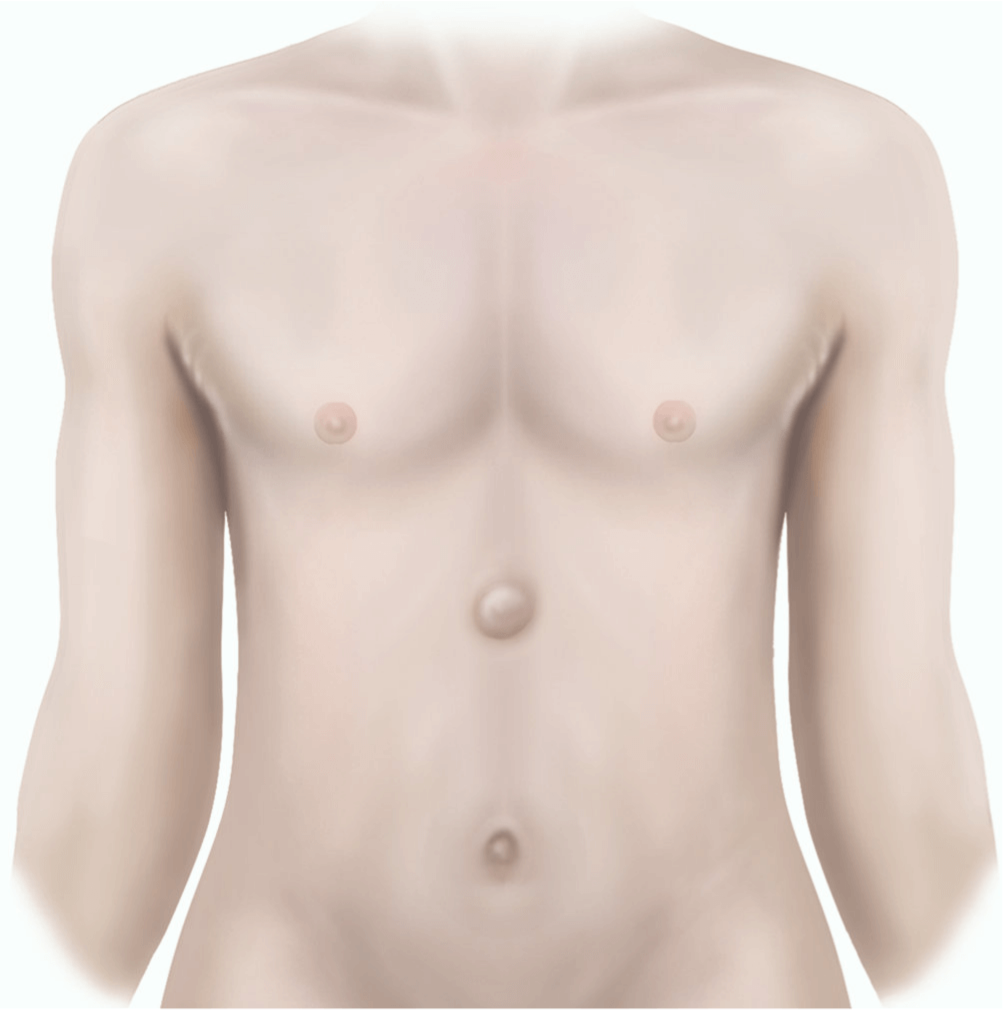 Illustration showing an epigastric hernia repair (adult).