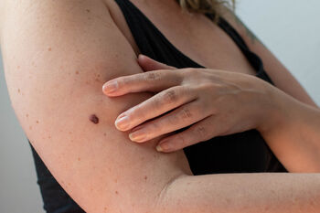 Melanoma, skin cancer