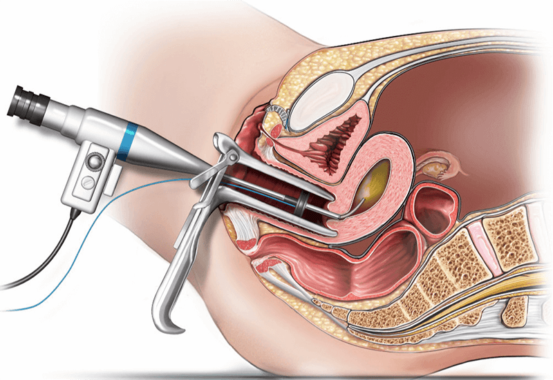 Illustration showing a hysteroscopy.