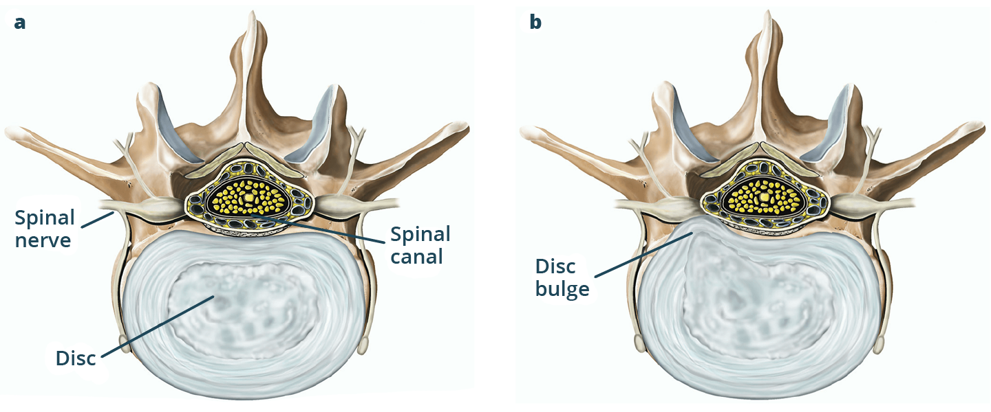 Illustration of a normal spinal canal and disc next to one with a disc bulge pressing on a spinal nerve.