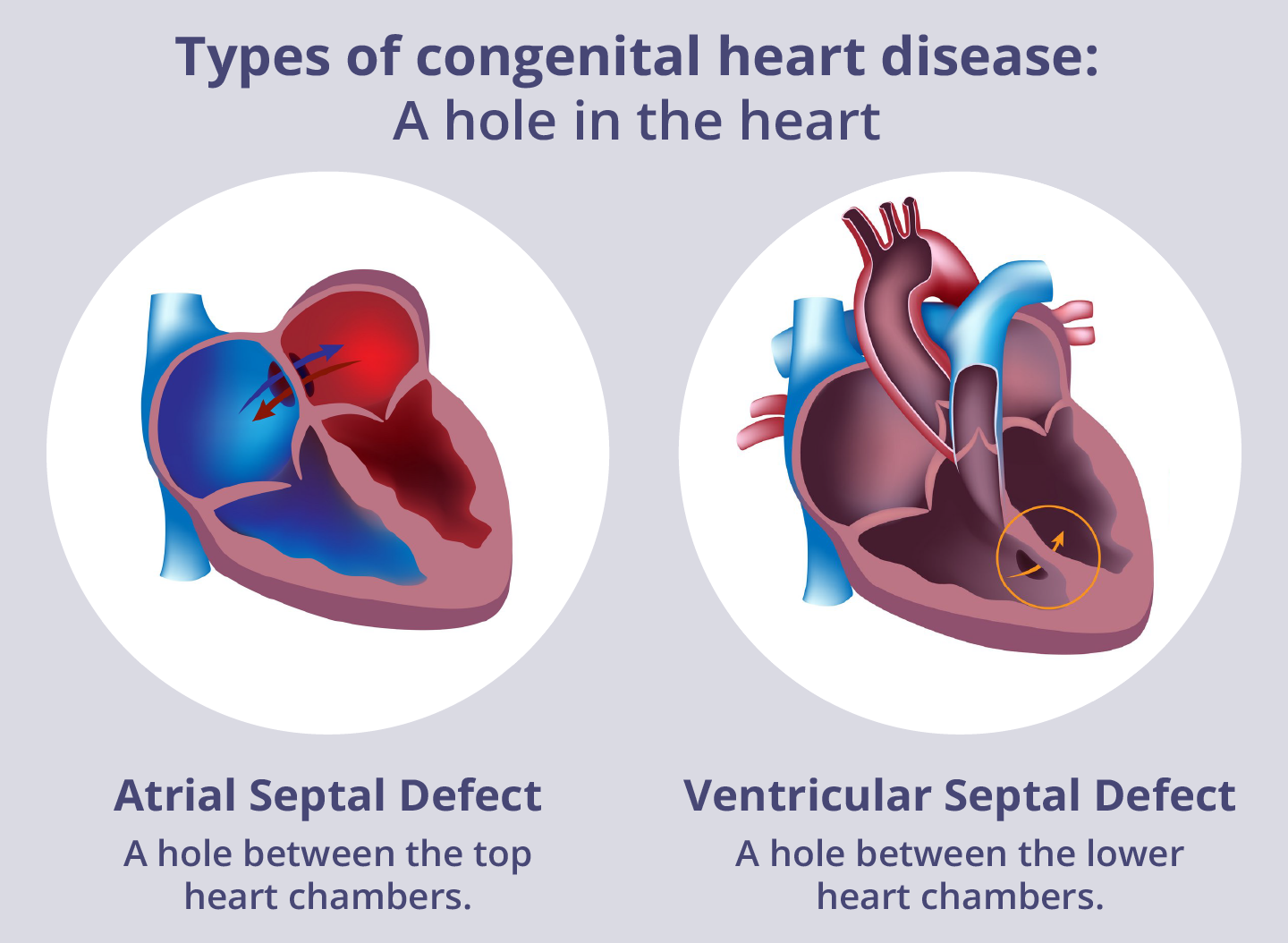 A hole in the heart (atrial or ventricular septal defect).