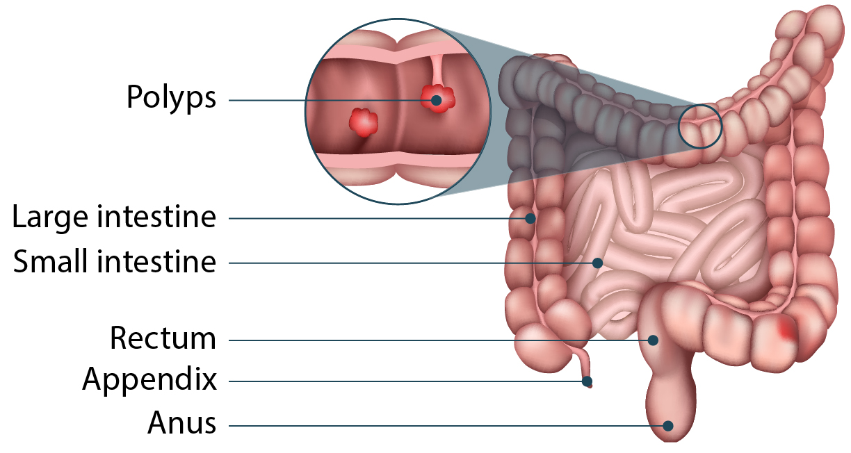 Diagram of polyps in the intestine.