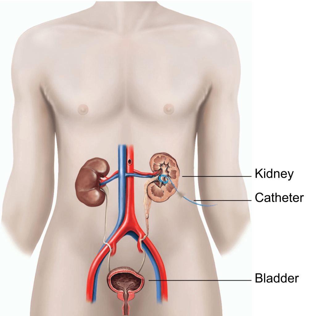 Illustration showing a nephrostomy.