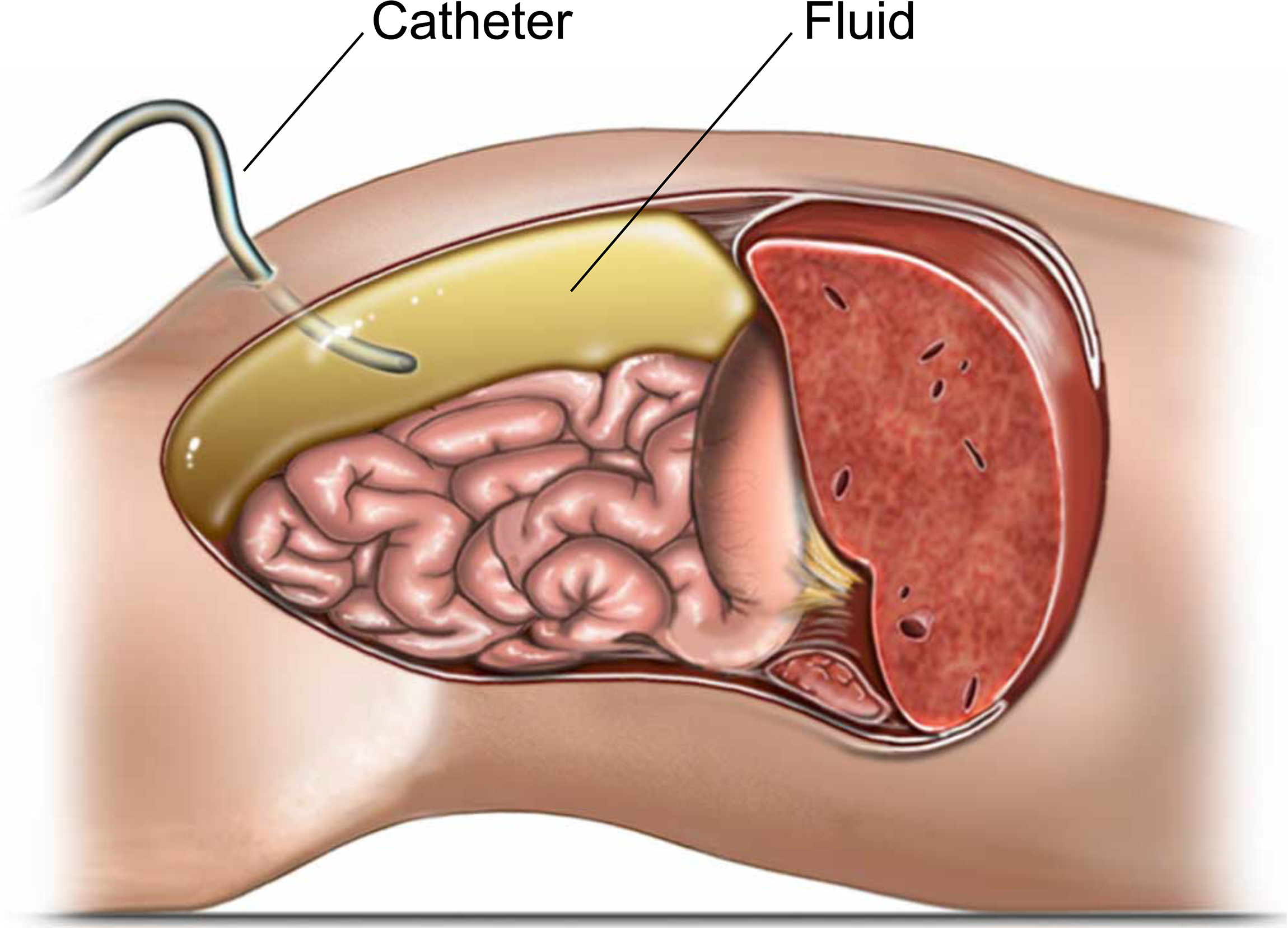 Illustration showing paracentesis.