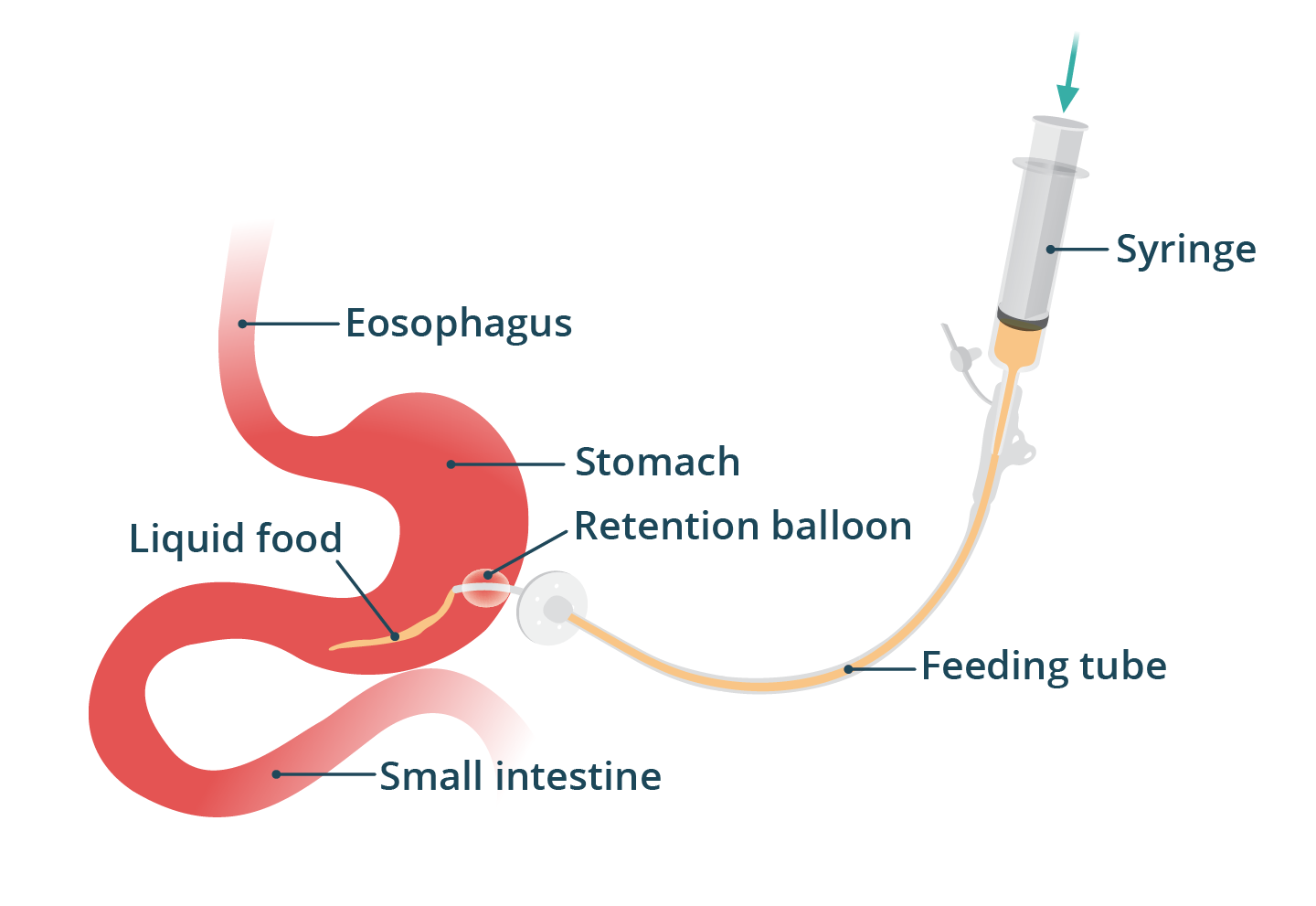A diagram showing a syringe injecting fluids directly into the stomach using a PEG tube.