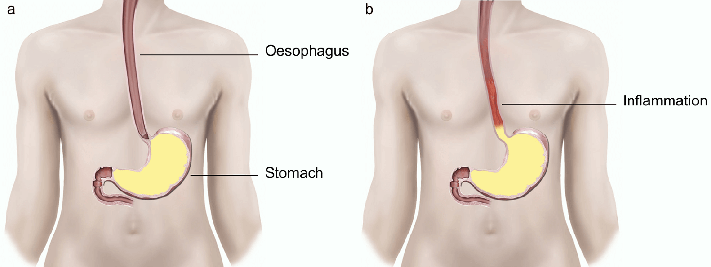 Illustration showing a normal valve and a faulty valve.