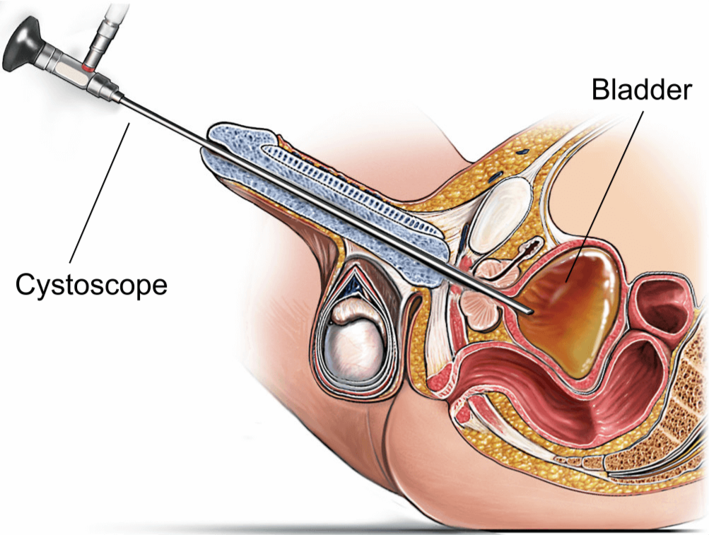 Illustration showing a rigid cystoscopy.