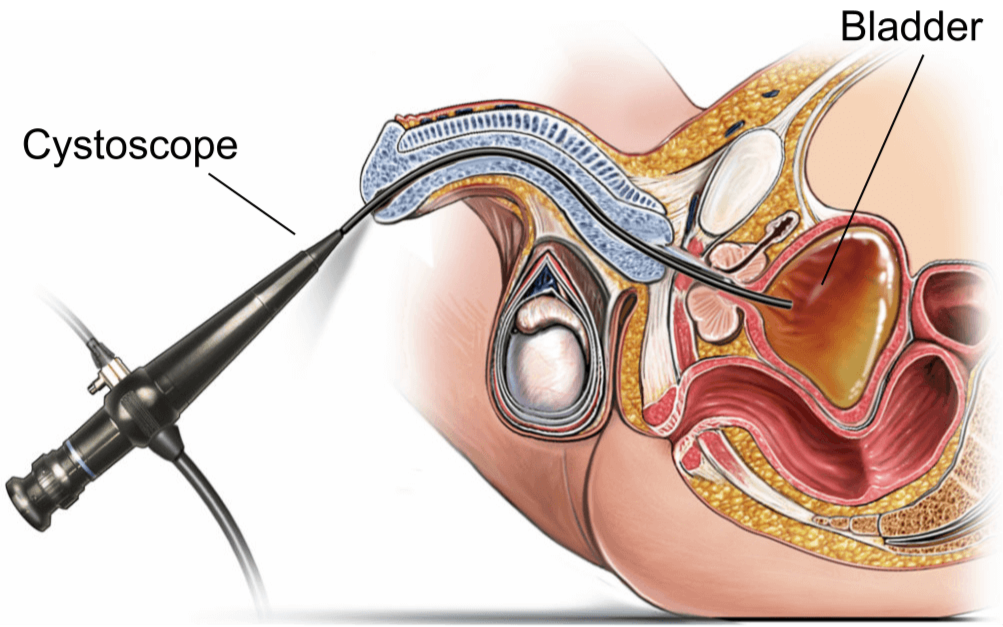Illustration showing a flexible cystoscopy.