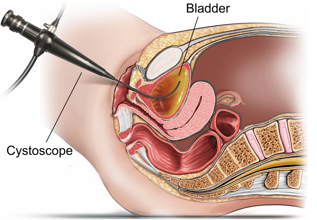 Illustration showing a flexible cystoscopy (female).