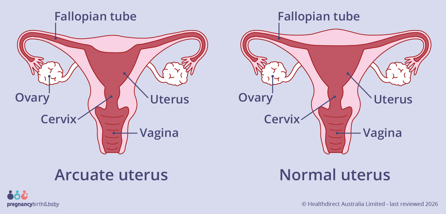 The arcuate uterus looks very similar to a normal uterus but has a small dip at the top of the womb.