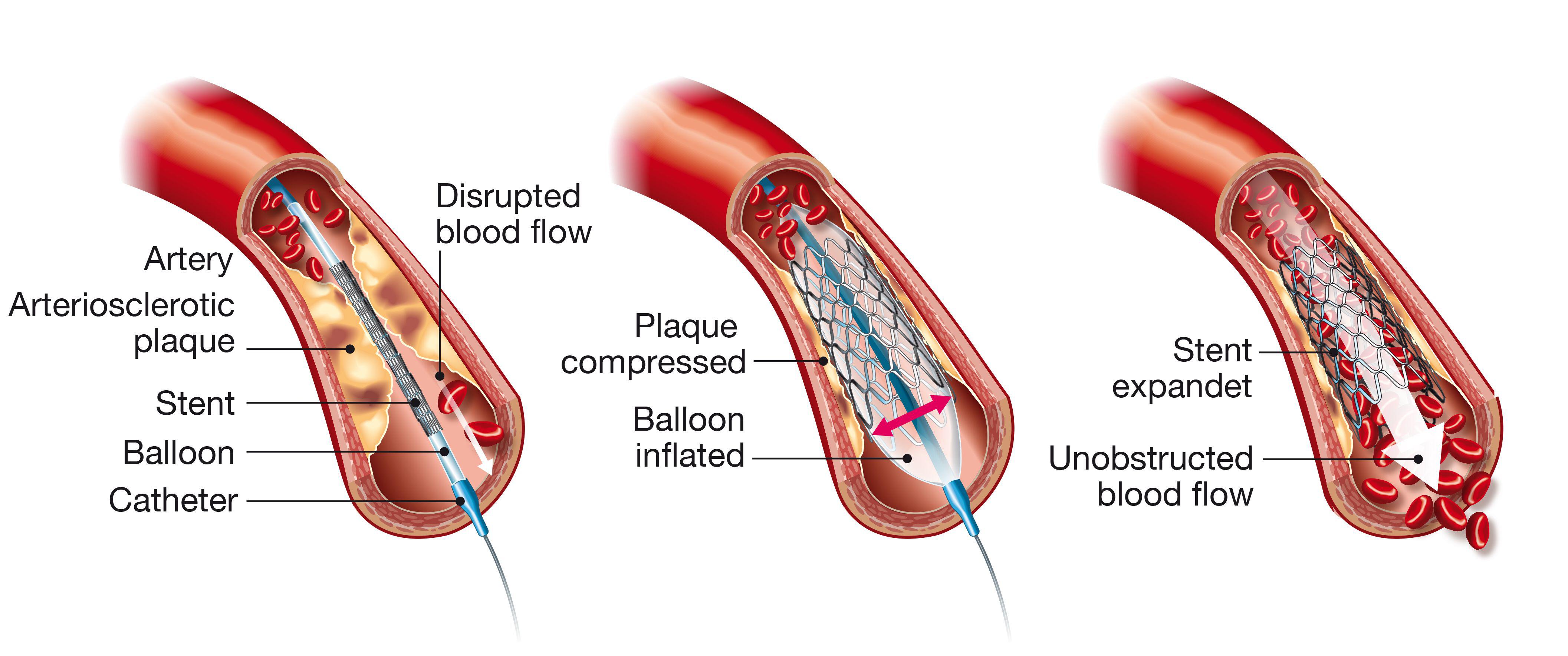 An illustration showing a stent, a wire mesh tube, inserted into the artery to keep it open.