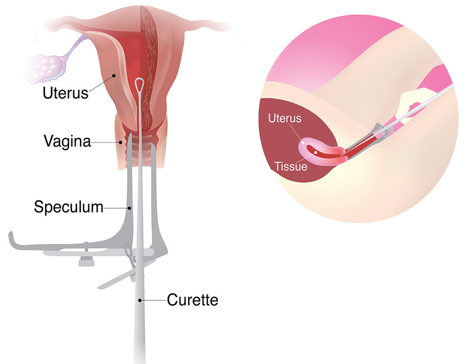 Illustration showing the steps involved in a D&C.