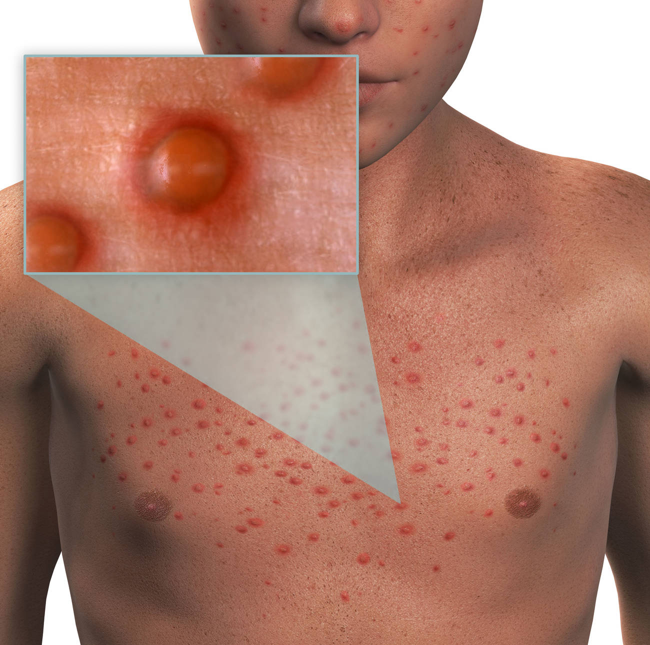 Illustration of chickenpox blisters