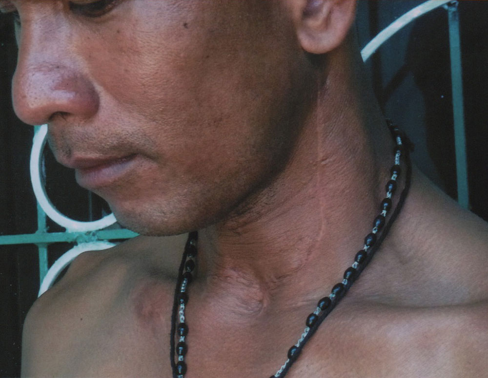Scars on Rentegrado&rsquo;s neck show where an attacker&rsquo;s bullet passed through his esophagus in 2009.