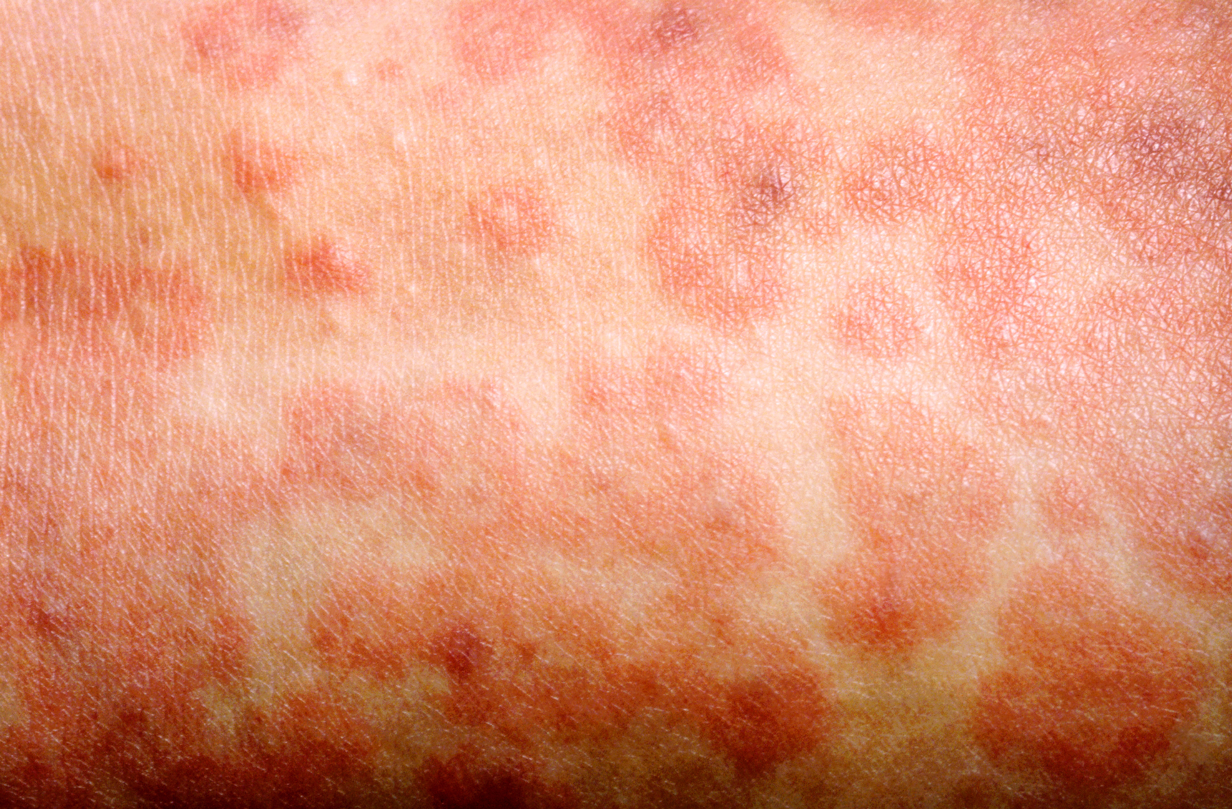 Image of measles rash.