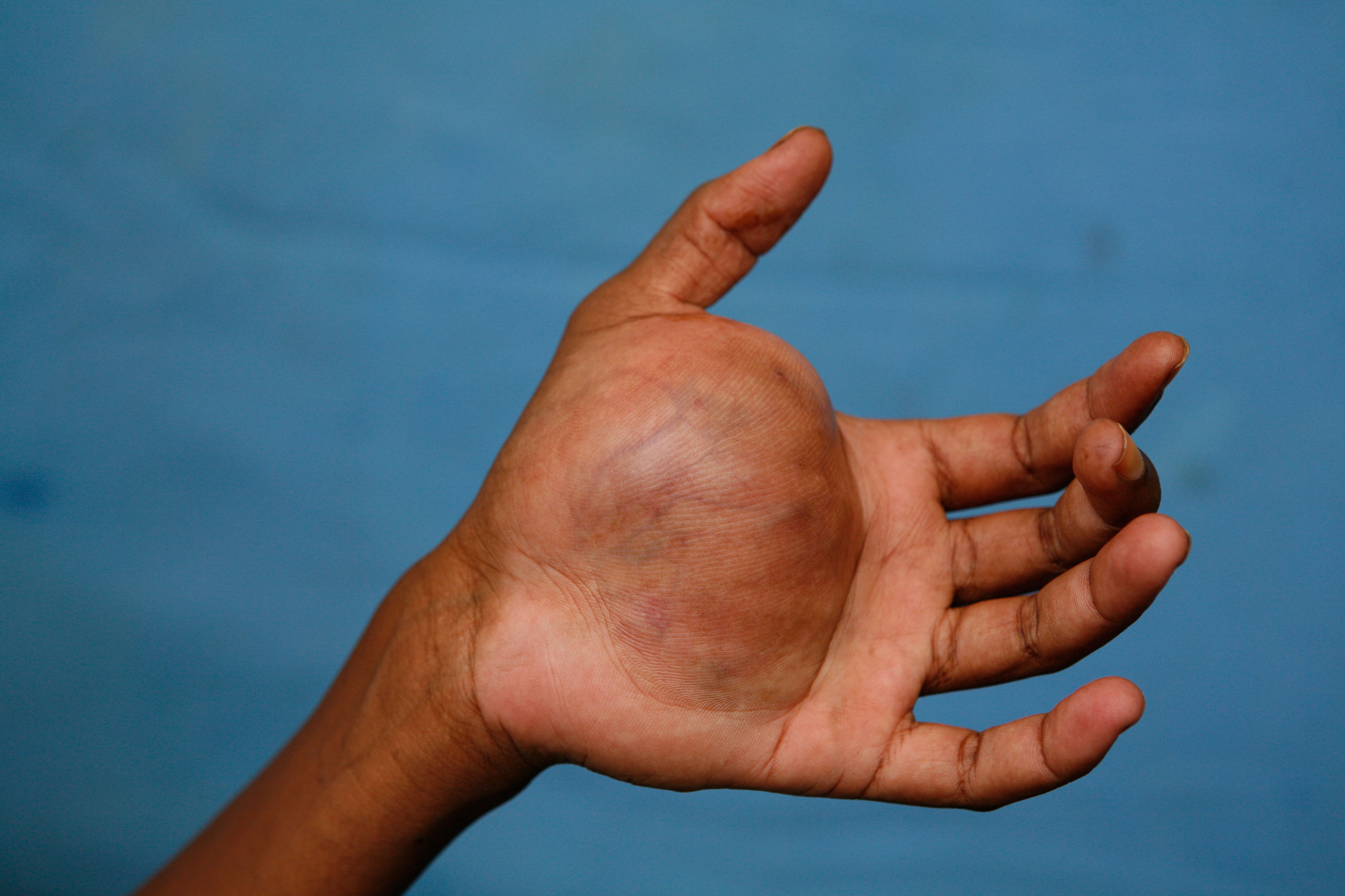 Image of a hand impacted by neurofibromatosis.