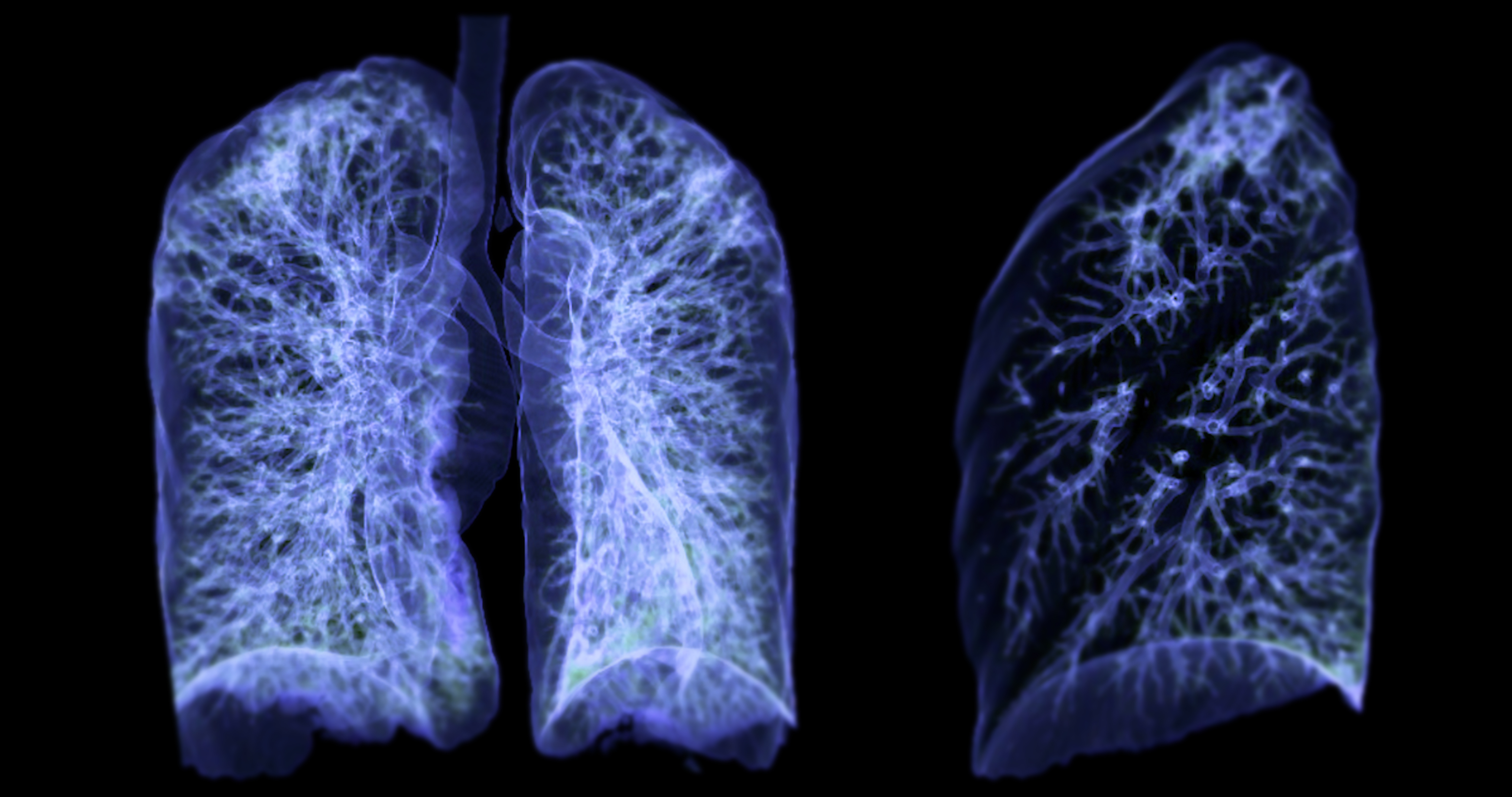 non small cell lung cancer 