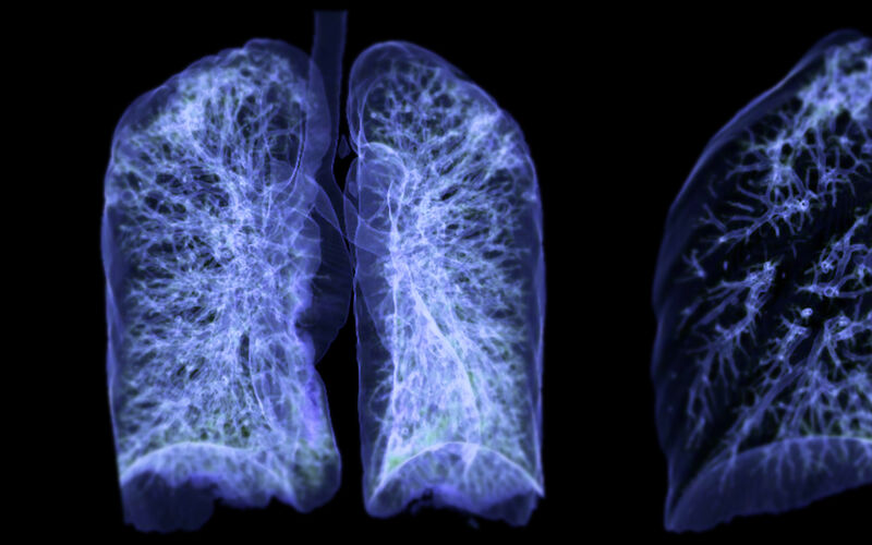 non small cell lung cancer 