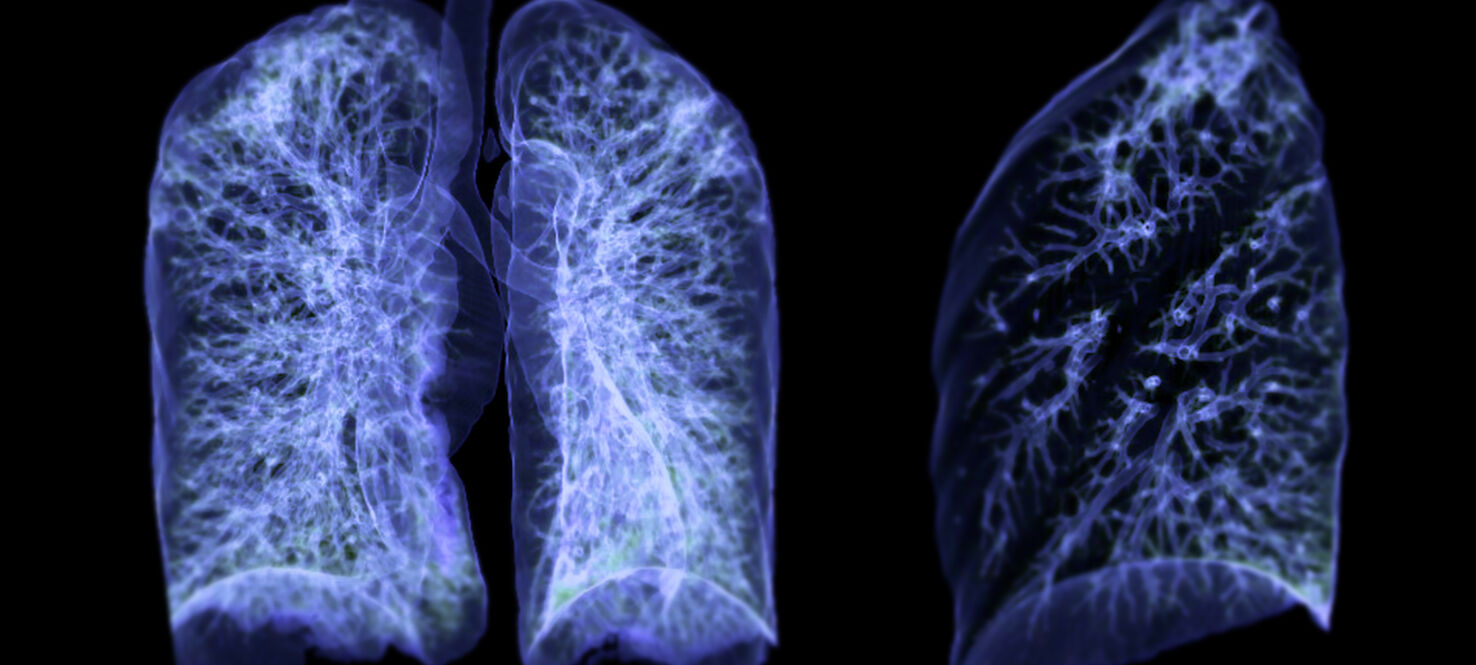 non small cell lung cancer 