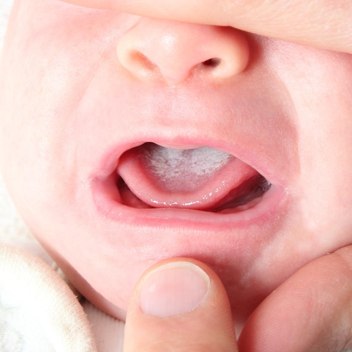 Image of a baby with oral thrush. Their mouth is gently held open, so you can see milky, white patches on the tongue.