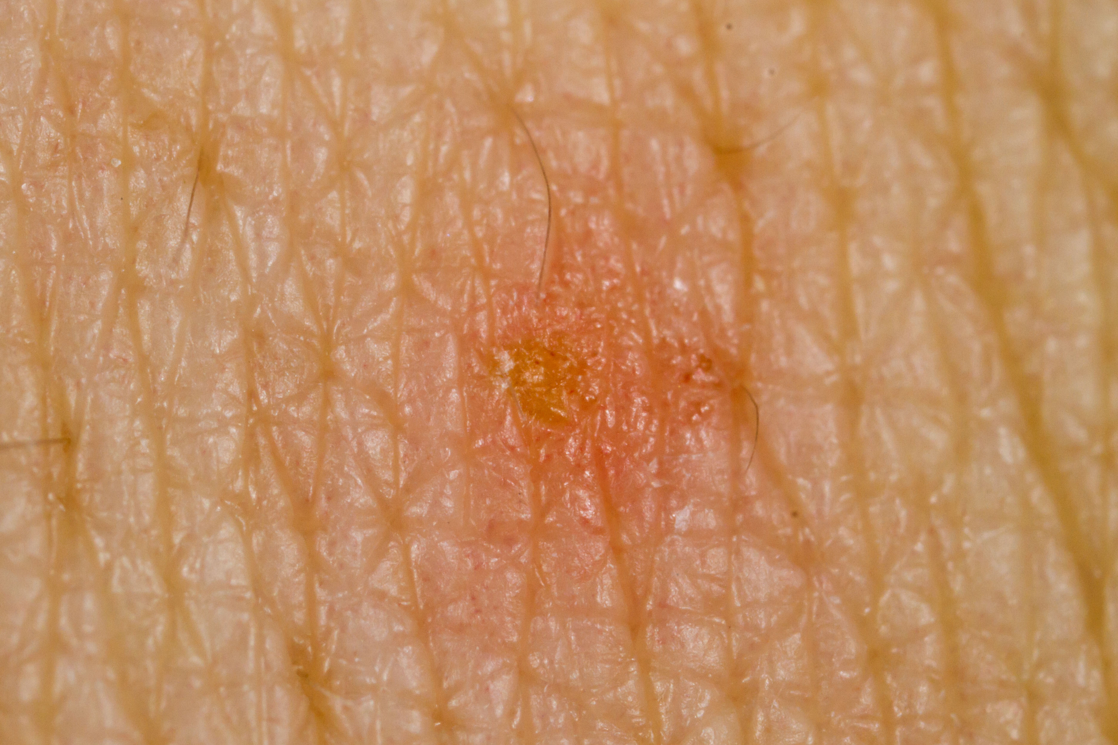 Scabies.