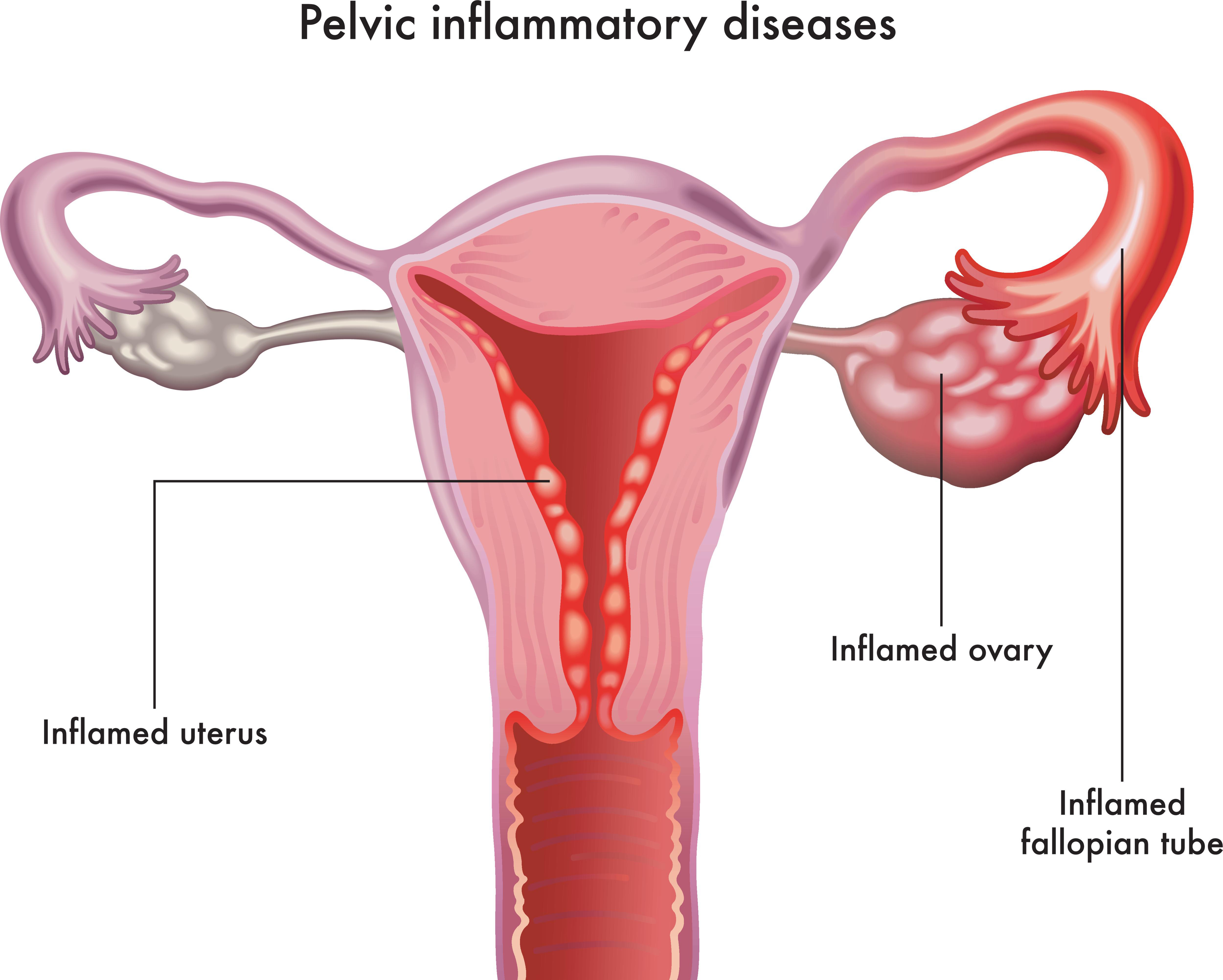 Illustration of the female reproductive system showing pelvic inflammatory disease, with inflammation in the ovary, fallopian tube and uterus.